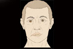 Bell's Palsy