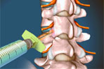 Facet Arthropathy - image courtesy of Advanced Pain Management