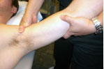 Utiliztion of Joint Mobilization Techniques to Treat Adhesive Capsulitis of the Shoulder