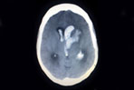 Update in Balance Therapy for Patients After a Cerebrovascular Accident: Assessment and Retraining