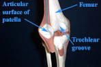 Chondromalacia Patella