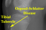 Osgood-Schlatter Disease / Syndrome