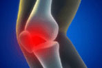 Understanding Patellofemoral Dysfunction