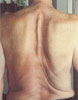 Spine Sign and Physical Therapy