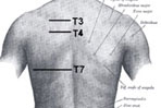 T4 Syndrome