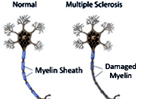 The Role of Physical Therapy in Multiple Sclerosis 