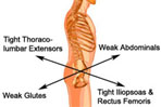 Lower Crossed Syndrome