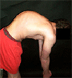 22 year old with Scheuermann's Disease - imgae from MusicNewz - Wikipedia: http://commons.wikimedia.org/wiki/File:Scheuermanns_diseasebl.jpg