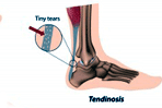 Tendinopathy - Itis vs. Osis