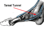 Tendinopathy - Itis vs. Osis