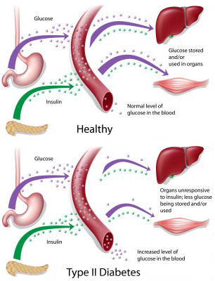 type 2 diabetes