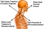 Upper Crossed Syndrome